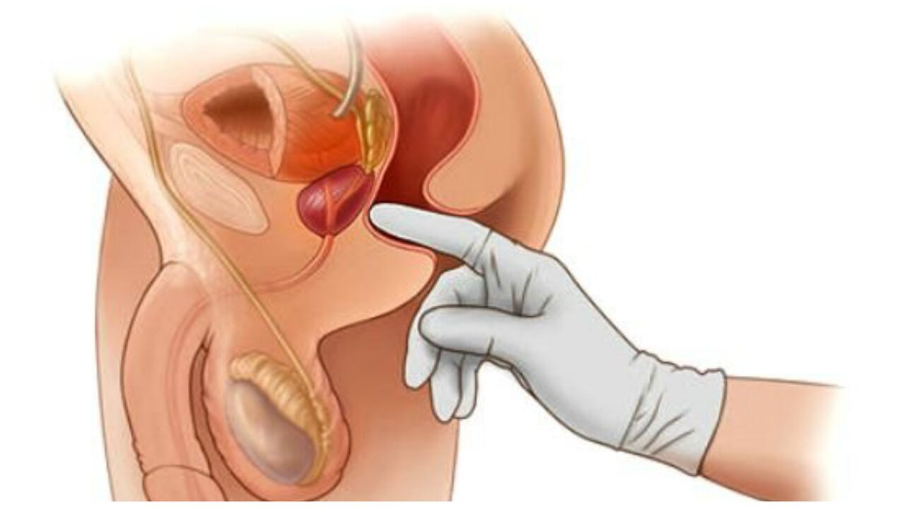 masáž prostaty pri chronickej prostatitíde