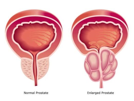 Normálna a zväčšená prostata