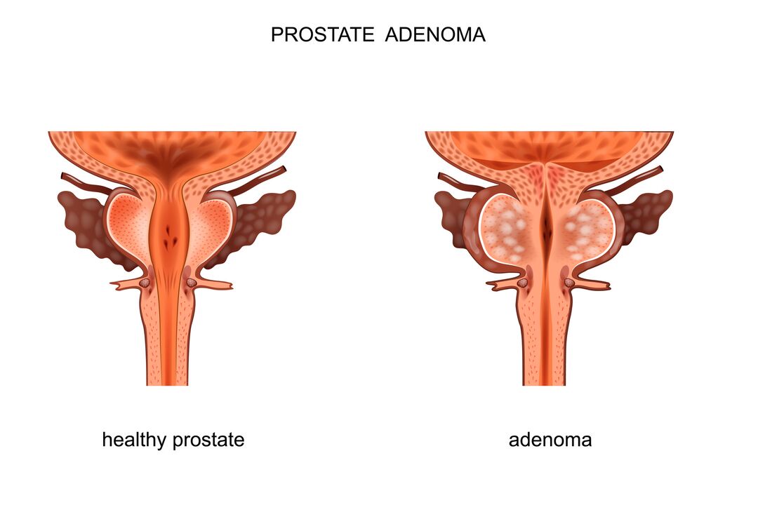 zdravá prostata a s adenómom